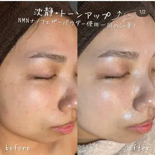 【ハーブピーリング/毛穴洗浄】NA skin 川崎店〜ニキビ・毛穴専門店〜所属・NAskin川崎 皆川のエステ・リラクイメージ