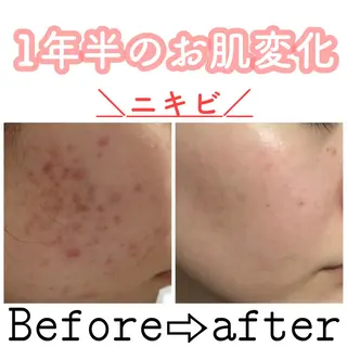 ロング カラー パーマ ヘアアレンジ メンズ キッズ ネイル マツエク・マツパ ニキビ&跡改善サロン オーナー光木のエステ・リラクイメージ