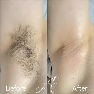 ショート A*[エースター] シュガーリング🍋のエステ・リラクイメージ