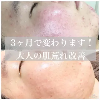 ニキビ毛穴改善 🌿ハーブピーリングのエステ・リラクイメージ