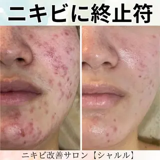 【ニキビ改善】 肌育ハーブピーリングのエステ・リラクイメージ