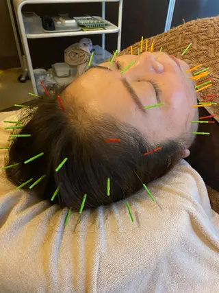 Acupuncture  salon LINOA リノア鍼灸院所属・ヘッドスパ鍼/小顔鍼 耳ツボ 　LINOAのエステ・リラクイメージ
