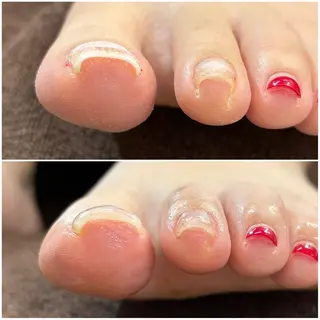 ネイル 巻き爪補正 Umber　Miyaのネイルデザイン