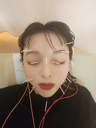 リフトアップ・たるみ ☆美容鍼小顔矯正のその他イメージ