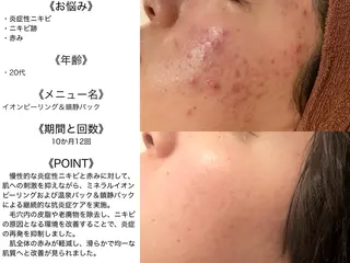 学生ニキビ改善🍀 優しい肌質改善のエステ・リラクイメージ