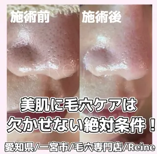 Reine BeautySalon所属・毛穴/シミ肝斑/脱毛 横山梨里のエステ・リラクイメージ