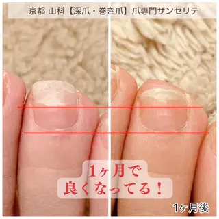 ネイル 深爪・巻き爪 専門サンセリテのネイルデザイン