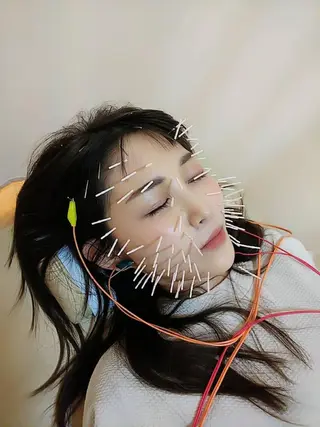 リフトアップ・たるみ ☆美容鍼小顔矯正のその他イメージ