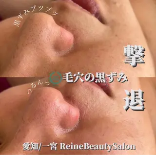 Reine BeautySalon所属・毛穴/シミ肝斑/脱毛 横山梨里のエステ・リラクイメージ