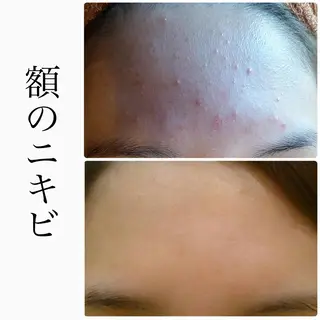 BeSkin藤沢店所属・ニキビ/肌質改善 BeSkin 藤沢店のエステ・リラクイメージ