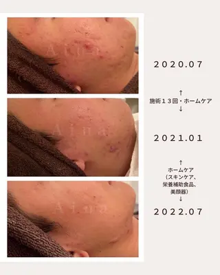 セミロング パーマ ヘアアレンジ メンズ キッズ ネイル マツエク・マツパ ニキビ跡専門サロン Ainaのエステ・リラクイメージ