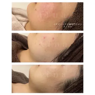 ニキビ跡専門サロン Ainaのエステ・リラクイメージ