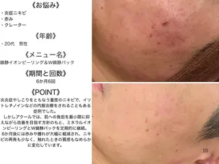 6万人の美肌実績🔥 最短ニキビ改善のエステ・リラクイメージ