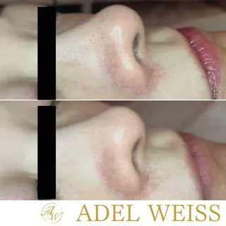 毛穴ケア＆脱毛サロン　ADEL WEISS所属・毛穴ケア＆脱毛サロン ADEL　WEISSのエステ・リラクイメージ