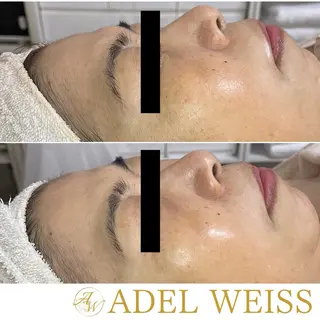 毛穴ケア＆脱毛サロン　ADEL WEISS所属・毛穴ケア＆脱毛サロン ADEL　WEISSのエステ・リラクイメージ