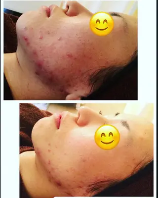 ニキビ/肌質改善専門 Snow skinのエステ・リラクイメージ