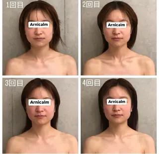 ハーブピーリング 肌再生ピーリング/のエステ・リラクイメージ