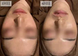 HINANO矢場町店【ヒナノ】所属・脱毛/肌改善🌿 HINANO 村田のエステ・リラクイメージ