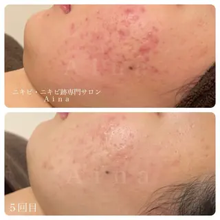 ニキビ跡専門サロン Ainaのエステ・リラクイメージ