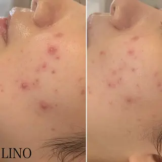 beautysalon  LINO所属・平日限定！お得！ 全メニュ¥5,500のエステ・リラクイメージ