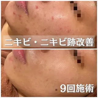 皮膚科より効果あり ⁉️最短ニキビ改善のエステ・リラクイメージ