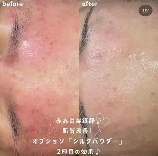 【ハーブピーリング/毛穴洗浄】NA skin 川崎店〜ニキビ・毛穴専門店〜所属・NAskin川崎 皆川のエステ・リラクイメージ