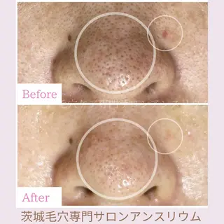 毛穴ケア専門サロンアンスリウム所属・茨城土浦 つくば毛穴 ケア専門サロンのエステ・リラクイメージ