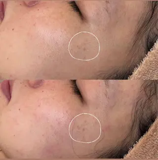 毛穴ケア/毛穴診断/ 毛穴洗浄〔心斎橋〕のエステ・リラクイメージ