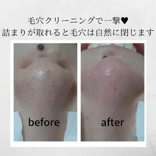 毛穴ケア・肌質改善 徳川のエステ・リラクイメージ