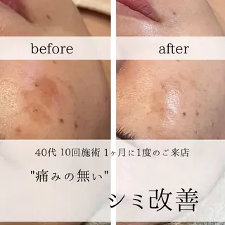 yc.hacci 【ハーブピーリング】のエステ・リラクイメージ