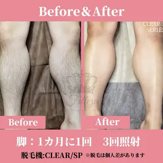 メンズ キッズ 有人型セルフサロン 脱毛/痩身/美顔のその他イメージ