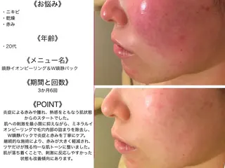 皮膚科より効果あり ⁉️最短ニキビ改善のエステ・リラクイメージ