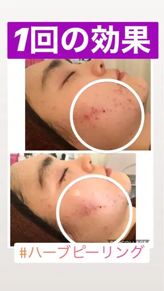 ニキビ/肌質改善専門 Snow skinのエステ・リラクイメージ