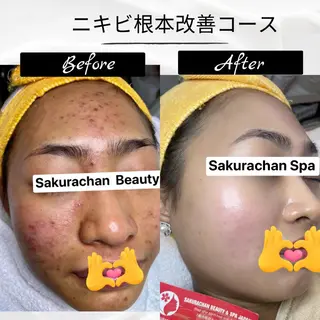 ニキビ、痩身、脱毛、 サクラチャンスパのエステ・リラクイメージ
