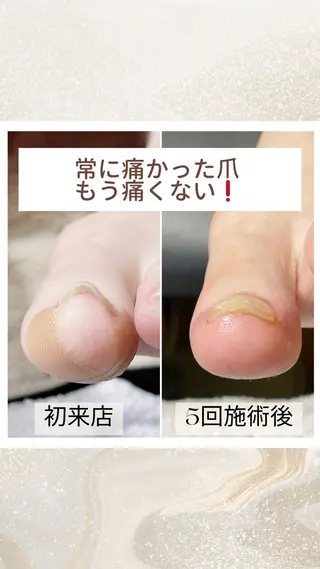 ネイル 深爪・巻き爪 専門サンセリテのネイルデザイン