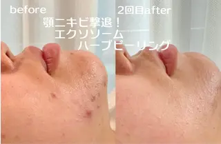 最速小顔・肌質管理 ❣️エスポワールのエステ・リラクイメージ