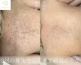 ハーブピーリング・毛穴ケア専門サロンSalon de LENA 栄店所属・ハーブピーリング専門 サロンドレナ　白藤のエステ・リラクイメージ