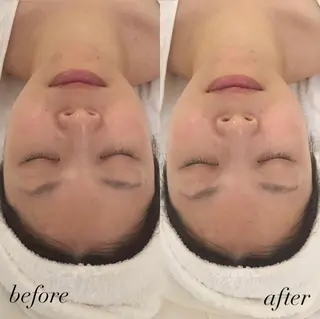 毛穴/ピーリング ララピール/POLAのエステ・リラクイメージ