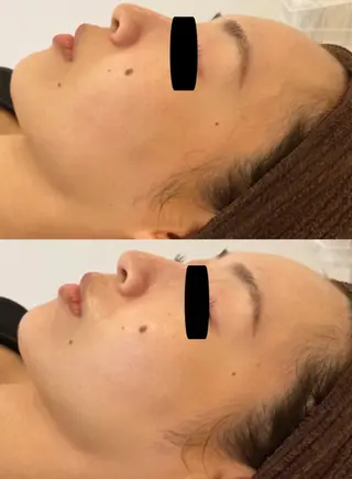 脱毛｜肌質改善｜ ROOM.Sのエステ・リラクイメージ