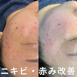 ニキビ・ニキビ跡改善 leoloのエステ・リラクイメージ