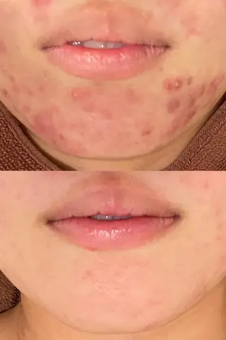 都内で出来る肌管理！ 最短ニキビ改善のエステ・リラクイメージ