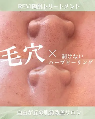 ハーブピーリング/韓国肌管理/フェイシャル/毛穴洗浄/眉毛/顔脱毛【糸脱毛専門】rev所属・肌質改善❤️美眉 脱毛🍒糸脱毛サロンのエステ・リラクイメージ