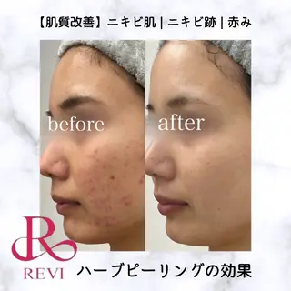 REVIハーブピーリング/バストケア/脱毛 Retea.【ルテア】所属・肌質改善|ニキビ| 毛穴|Retea.のエステ・リラクイメージ