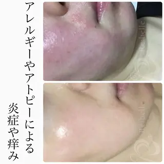 BeSkin藤沢店所属・ニキビ/肌質改善 BeSkin 藤沢店のエステ・リラクイメージ