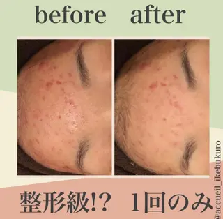 皮膚科より効果あり ⁉️最短ニキビ改善のエステ・リラクイメージ