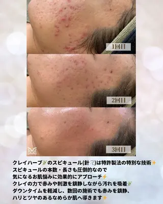 VIKI BEAUTY  クレイハーブピーリング・美肌脱毛専門店所属・VIKI BEAUTYのエステ・リラクイメージ