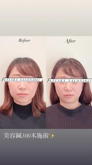 美容鍼灸サロン　TIARA所属・鍼灸サロン TIARA　美容鍼のエステ・リラクイメージ