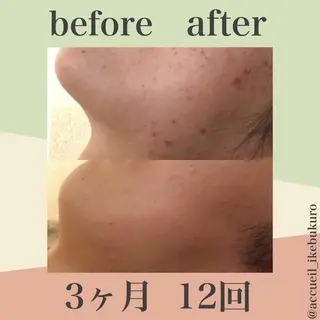 皮膚科より効果あり ⁉️最短ニキビ改善のエステ・リラクイメージ