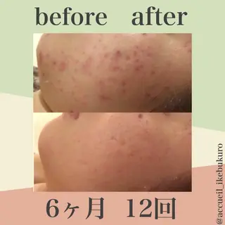 皮膚科より効果あり ⁉️最短ニキビ改善のエステ・リラクイメージ