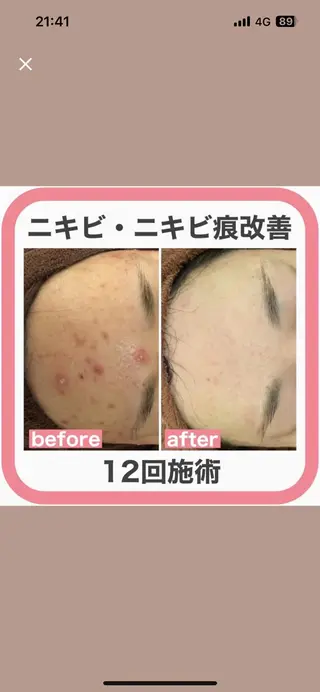 学生ニキビ改善🍀 優しい肌質改善のエステ・リラクイメージ